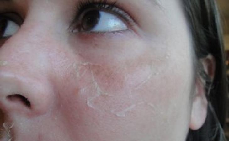 Как избавиться от шелушения кожи на лице Средство против шелушения
